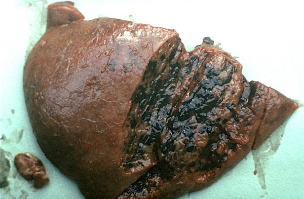 Hepatosis dietetica lesions - pig's liver