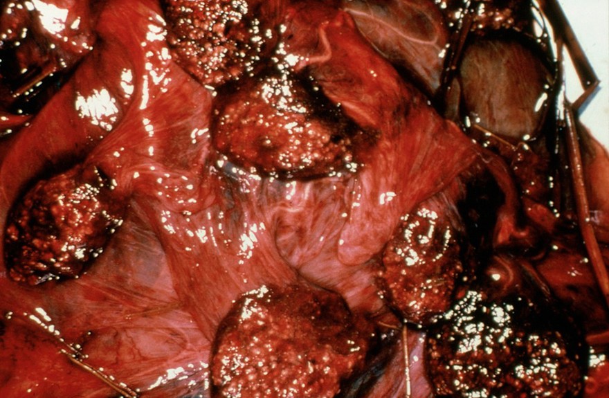 Toxoplasmosis: ewe's placenta, microscope