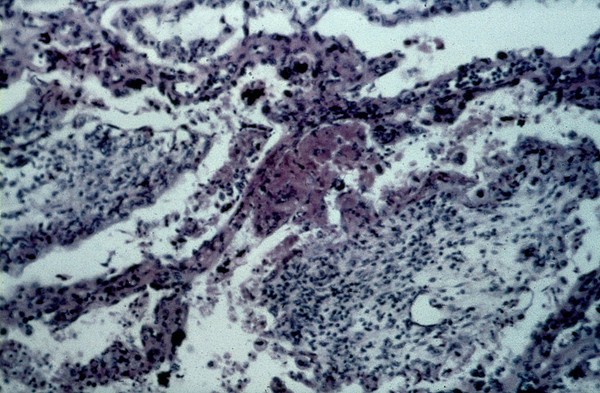 Toxoplasmosis: histological section placenta