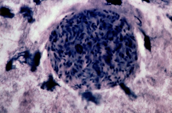 Toxoplasmosis: cyst in mouse brain.