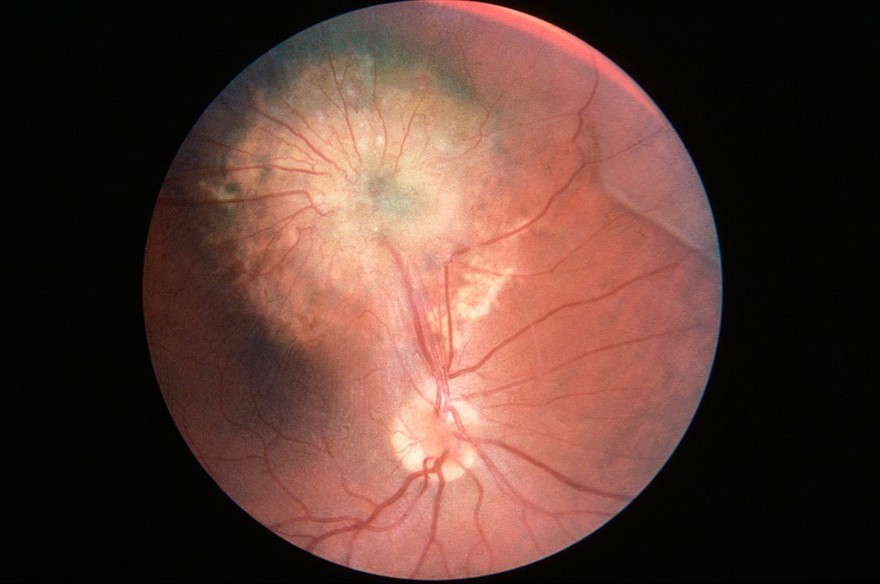 Toxocaral choroidoretinitis: human retina