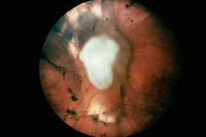 view Toxocaral choroidoretinitis: human retina