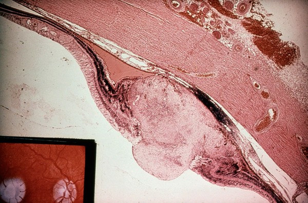 Toxocaral retinal granuloma in a human