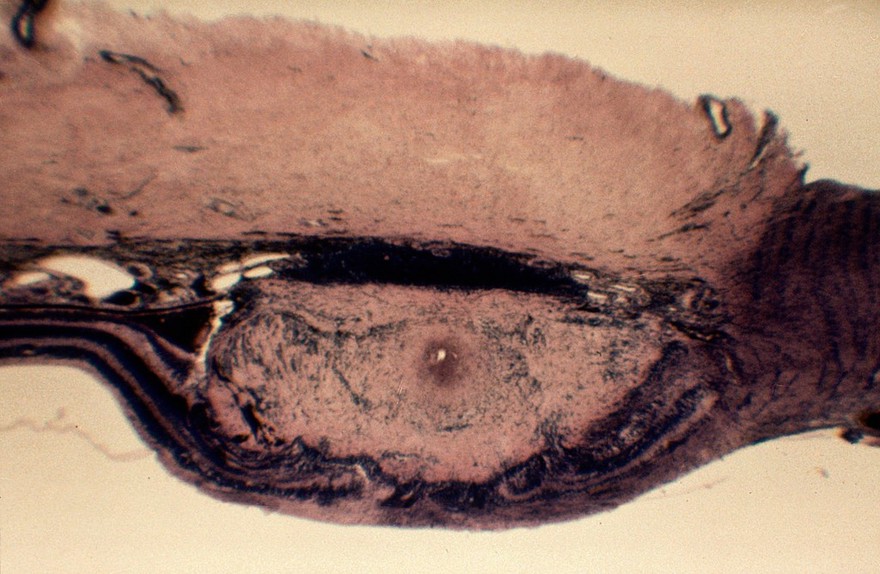 Toxocariasis: section through infected eye