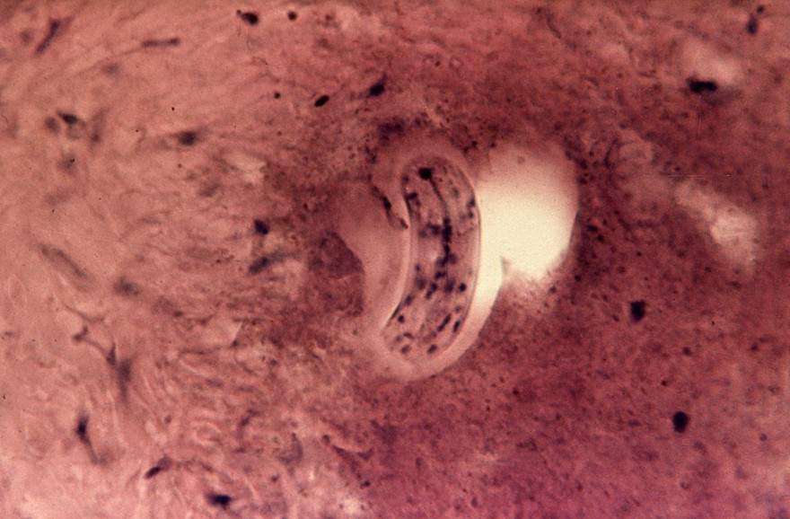 Toxocariasis in man: high powered view larva