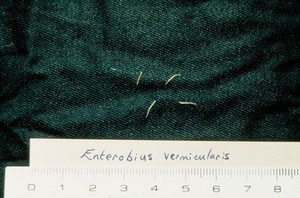 view Toxocariasis: enterobius vermicularis worms.