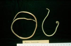 view Toxocariasis: ascaris lumbricoides worms.