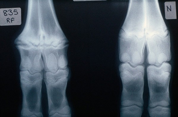 Radiograph comparing copper deficient & not