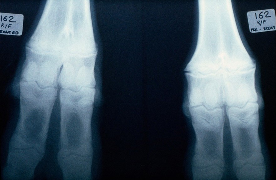 Radiograph: copper deficient fetlocks (cow)