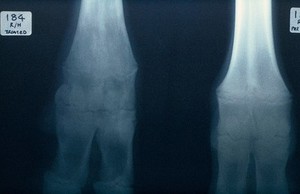 view Radiograph: copper deficient fetlocks (cow)