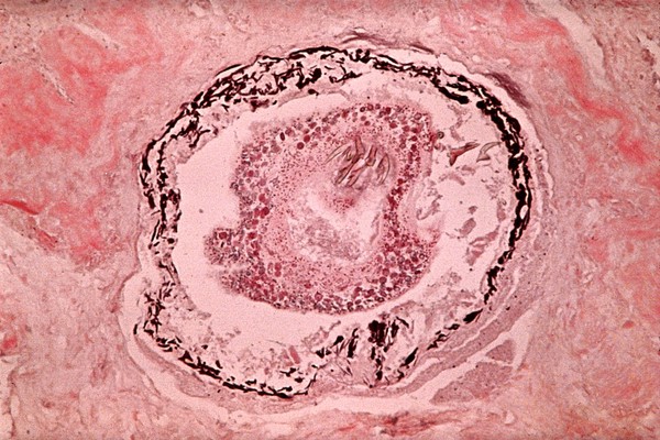 A cestode cyst in wall of snake's intestine