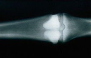 view Radiograph: loss contrast when KV increased