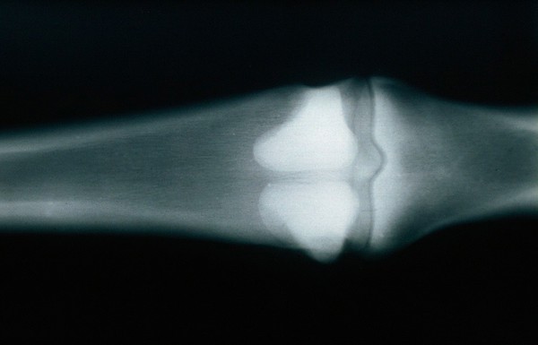 Radiograph: loss contrast when KV increased