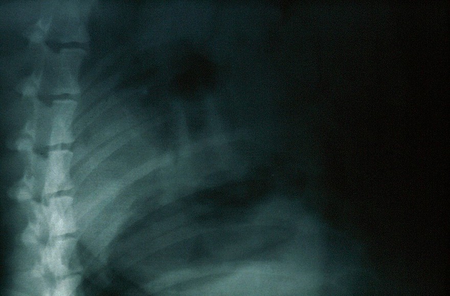 Radiograph: poor quality taken without grid