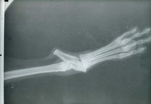 Radiograph: over-exposed & under-developed