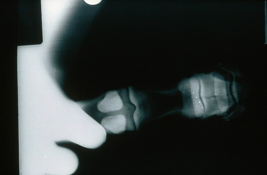 Radiograph: hand in glove in primary beam.
