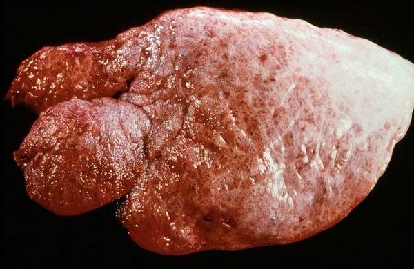 Emphysema of lung due to lungworm infection