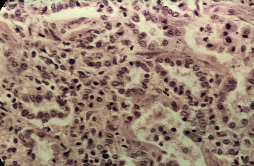 Alveolar epithelialisation (on a cow)