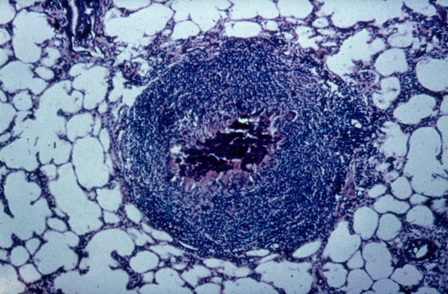 Lungworms in cattle: bronchiolar obstruction in