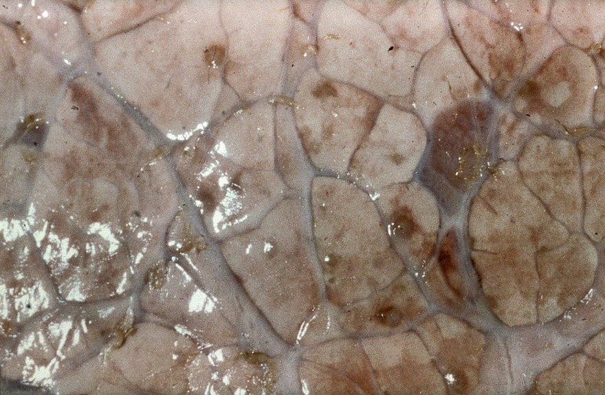 Lymphoid nodules in lung due to lungworm