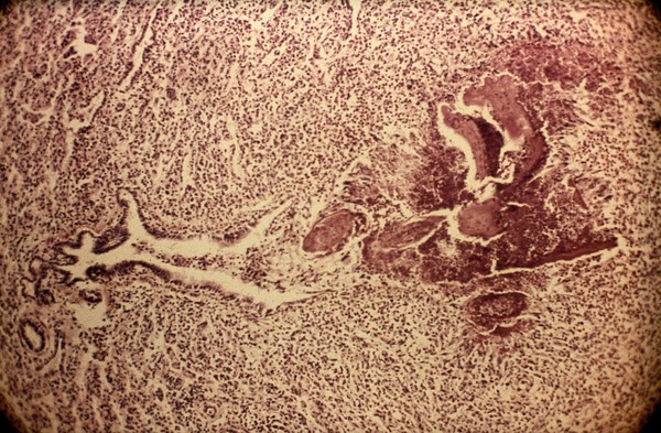 Lymphoid nodules in lung due to lungworm