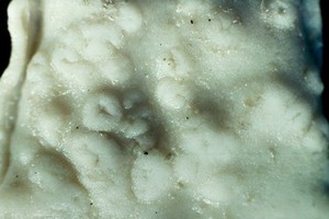 view Bovine abomasum: nodule due to o.ostertagi