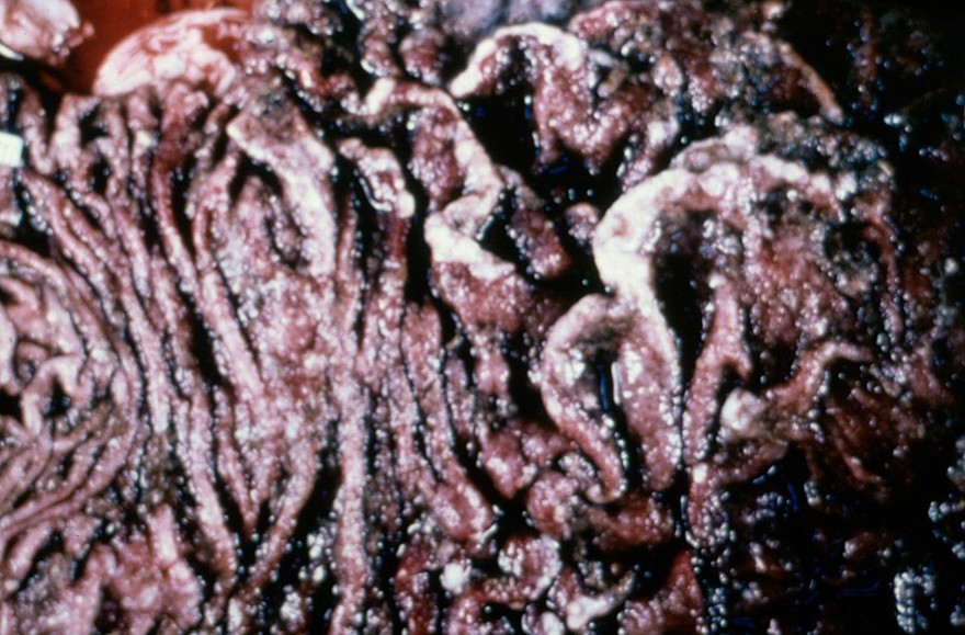 Bovine abomasum: acute ostertagiasis. (Note: