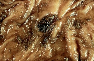 view Worms in horses: triodontophorus spp. feeding.