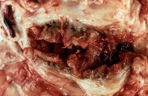 view Worms in horses: arteritis due to s.vulgaris