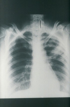 Radiograph: human case of psittacosis showing