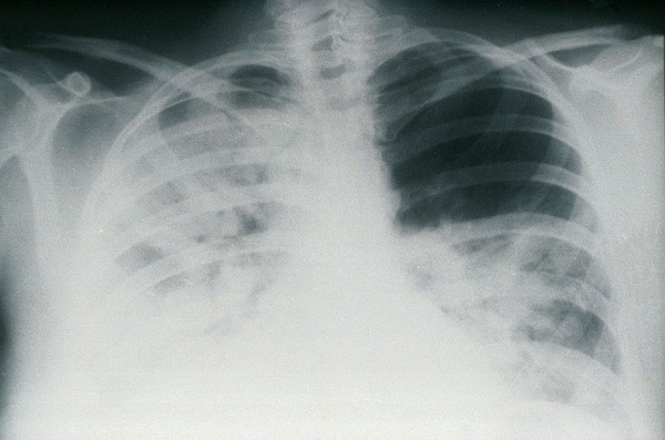 Radiograph: human case of psittacosis -