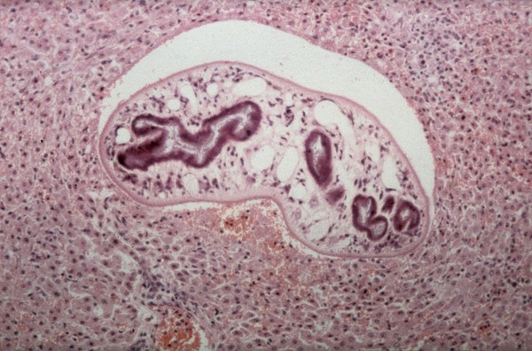 Migrating fluke in liver parenchyma