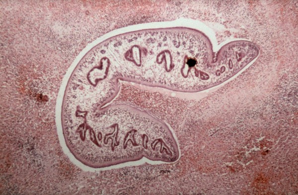 Migrating fluke in liver parenchyma