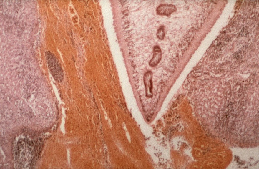 Migrating fluke in liver parenchyma