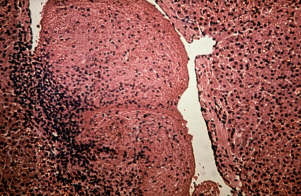 Liverfluke: mural thrombus in cattle liver