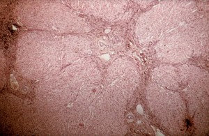 view Liverfluke: hepatic cirrhosis - still plenty of