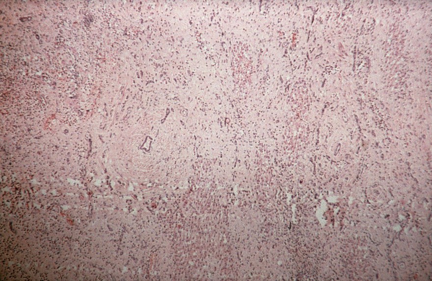 Liverfluke: hepatic cirrhosis - almost all normal