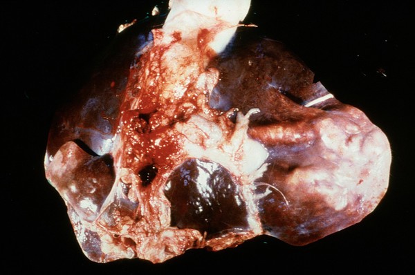 Liverfluke: severe hepatic cirrhosis and bile duct