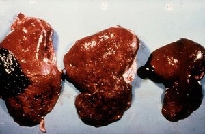 view Liverfluke: livers in acute fascioliasis