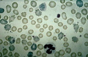 view Liverfluke: blood - sub-acute fascioliasis