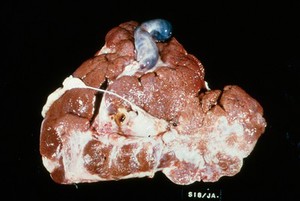 view Liverfluke: liver in chronic fascioliasis in