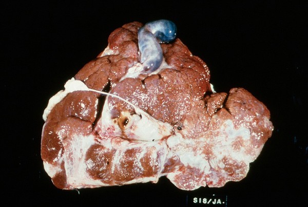 Liverfluke: liver in chronic fascioliasis in