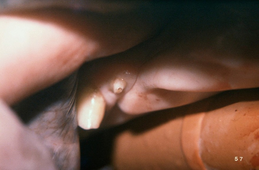 A horse's wolf tooth.