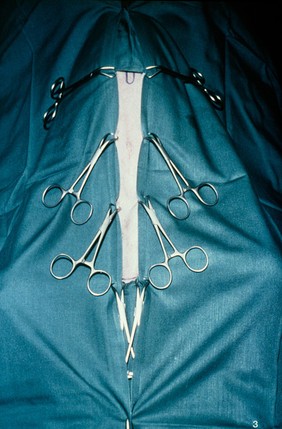 Method of draping: prior to operation