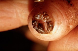 view A cow's teat orifice showing abnormality