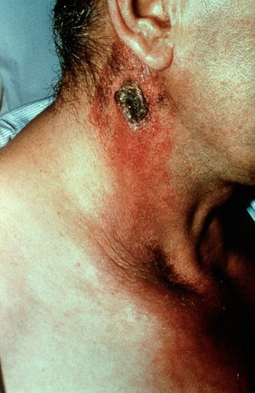 Meat handler: skin lesion of anthrax