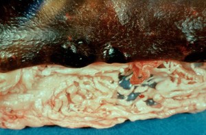 view Acute erysipelas in the pig, post-mortem