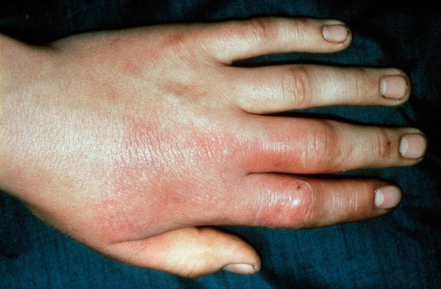 Erysipeloid in man - from meat handling