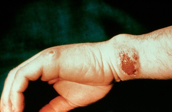 Meat handler's hand with skin infection