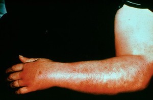 view Meat handler's arm: cellulitis as a result of